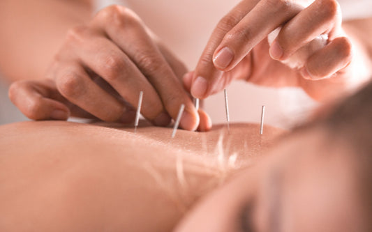 Akupunkturnadeln auf dem oberen Rücken einer Frau. 