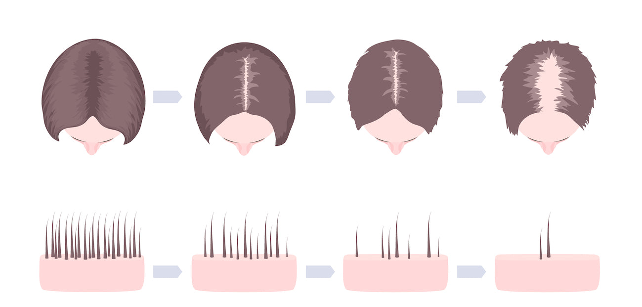 Grafik mit unterschiedlichen Stufen des Haarausfalls.